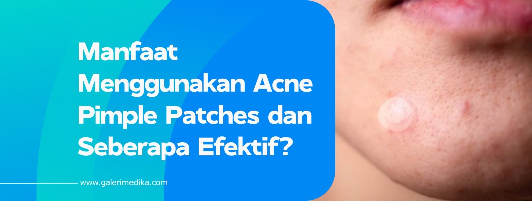 Manfaat Menggunakan Acne Pimple Patches dan Seberapa Efektif?