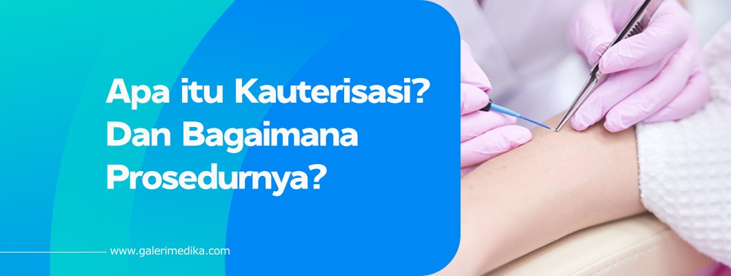 Apa itu Kauterisasi? Dan Bagaimana Prosedurnya?