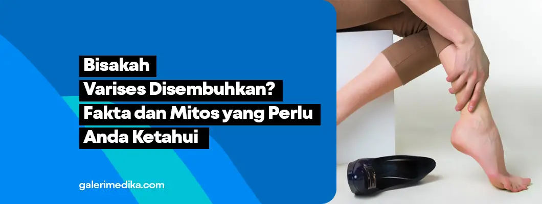 Bisakah Varises Disembuhkan? Fakta dan Mitos yang Perlu Kamu Ketahui