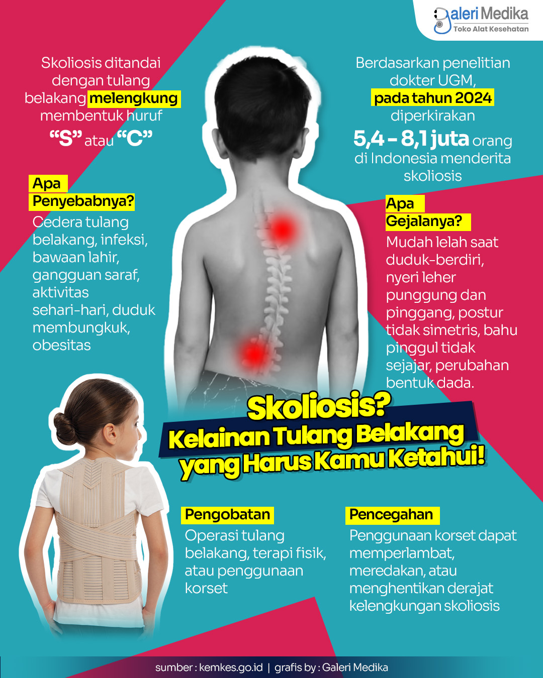 Infografis: Skoliosis? Kelainan Tulang Belakang yang Harus Kamu Ketahui